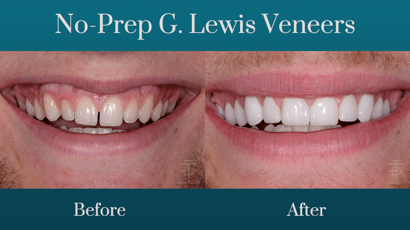 before and after with G Lewis